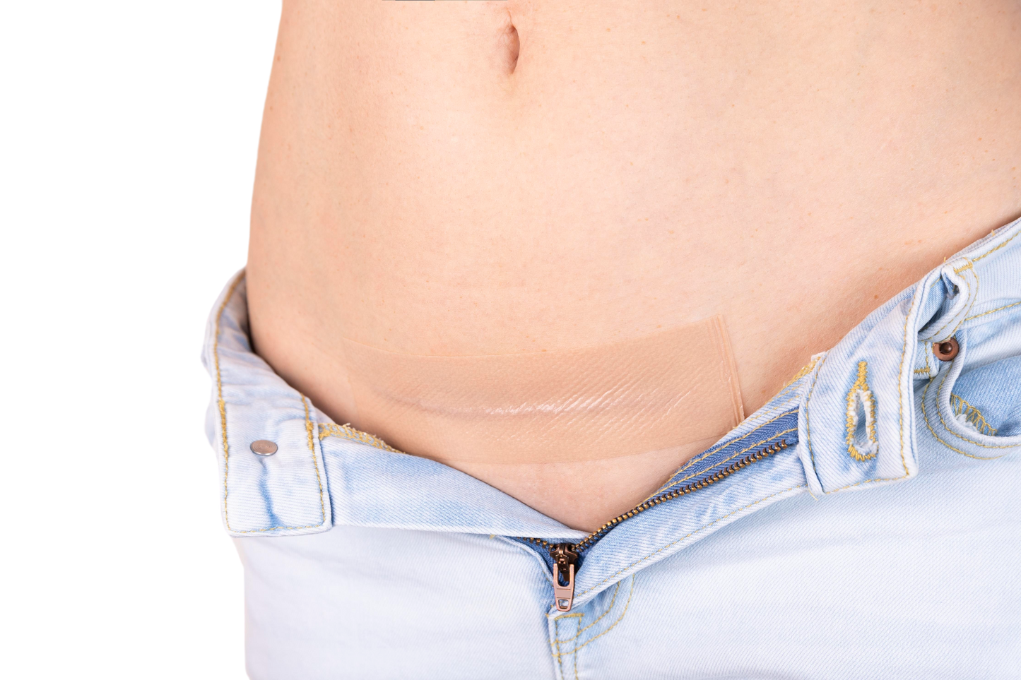 Dermaclar Siliconefusion C-Section Scar Patch